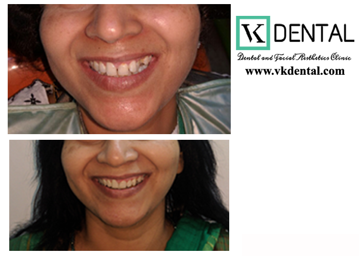 SMILE CORRECTION/DESIGNING
